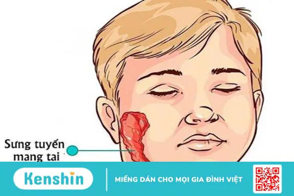 Trẻ bị quai bị nên kiêng những gì?