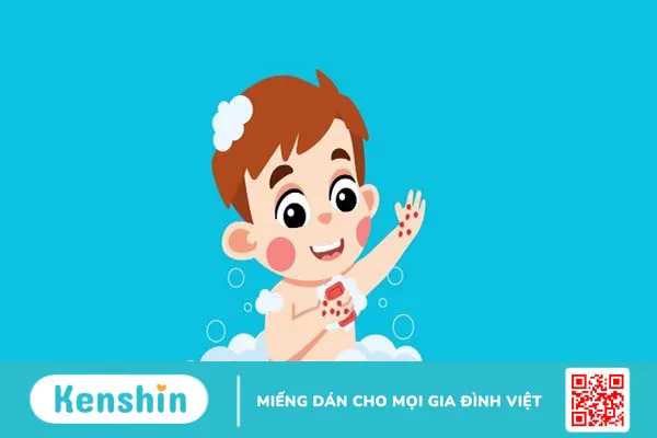 Trẻ bị tay chân miệng có tắm được không? Cách chăm sóc đúng cách