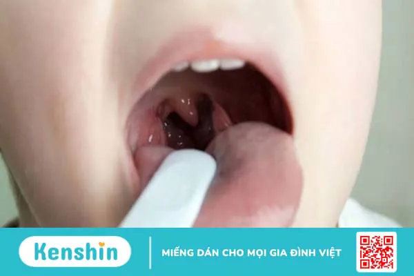 Trẻ ngủ ngáy có sao không? 9 nguyên nhân cảnh báo mà ba mẹ cần lưu ý