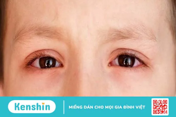 Trẻ sơ sinh bị đau mắt đỏ: Nguyên nhân do đâu và cách xử lý