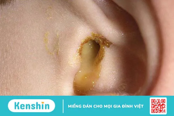 Triệu chứng viêm tai ngoài giúp bạn nhận biết bệnh chính xác