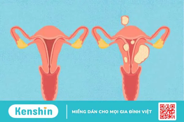 U xơ tử cung kiêng ăn gì? 7 loại thực phẩm nên ăn và nên tránh