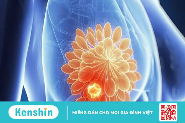 Ung thư vú có chữa được không? Phương pháp điều trị ung thư vú