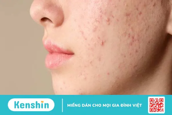 Uống tinh dầu hoa anh thảo có trị hết mụn nội tiết không?