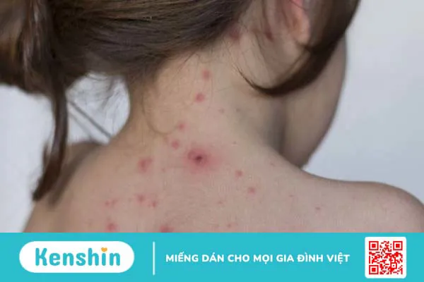 Vắc xin thủy đậu phải tiêm bao nhiêu mũi và nên tiêm khi nào?