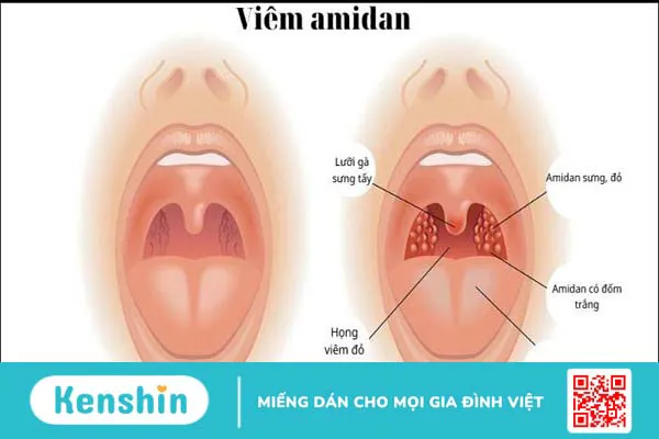 Viêm amidan thì nên ăn gì kiêng gì để nhanh khỏi bệnh