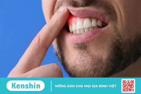 Viêm lợi kiêng ăn gì? 18 thực phẩm nên ăn, kiêng ăn nhanh khỏi bệnh