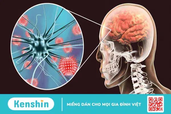 Viêm màng não có nguy hiểm không? 4 biến chứng viêm màng não