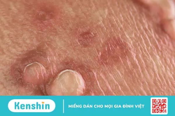 Virus HPV có thể gây ra bệnh gì?